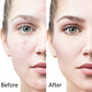 6-in-1 Microneedling Derma Roller Kit